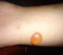 皮肤是人体自带的血糖仪？应急总医院内分泌科主任医师王凯亮介绍说，皮肤作为人体最大的器官，其健康状况往往能直观反映身体内部环境，尤其是血糖水平的异常